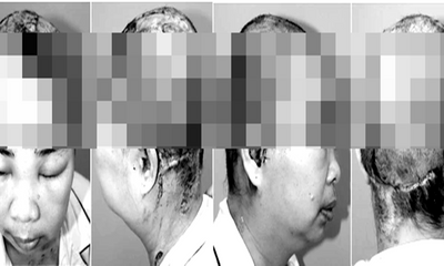  Ghép thành công mảnh da đầu bị đứt rời cho người phụ nữ bị cuốn vào máy khoan giếng