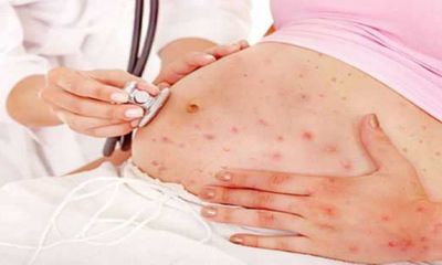 Những biến chứng cực nguy hiểm nếu phụ nữ đang mang thai mắc sốt xuất huyết