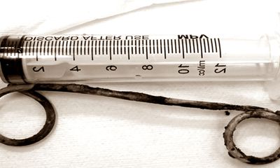 Cảm thấy đau bụng âm ỉ cụ bà đi khám thì phát hiện stent nhựa dài 15 cm bị bỏ quên trong ống mật