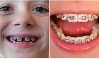Những điều bố mẹ cần biết về niềng răng ở trẻ