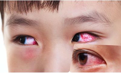 Hải Dương: Ghi nhận 106 chùm ca bệnh đau mắt đỏ tại các trường học