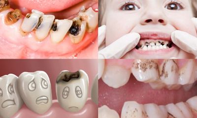 Những dấu hiệu cảnh báo sâu răng, nguyên nhân và cách phòng tránh