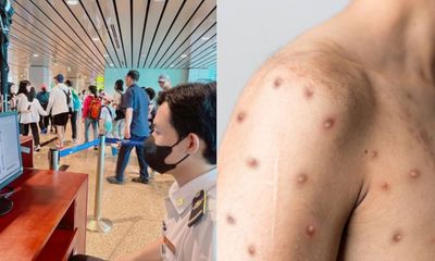 Khánh Hòa: Chủ động phòng bệnh đậu mùa khỉ, nhất là nhóm có nguy cơ cao
