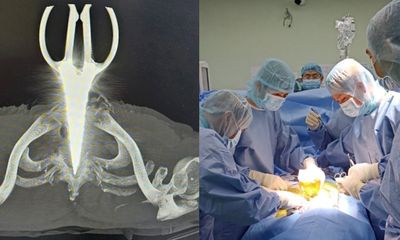 Phẫu thuật thành công cứu sống bệnh nhân bị kéo đâm xuyên cổ