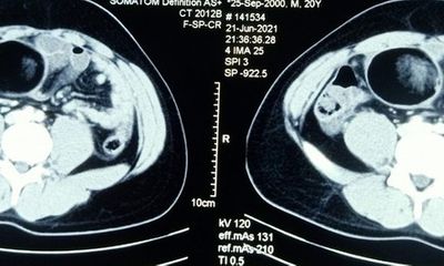 Tin tức đời sống ngày 28/6: Phẫu thuật cắt bỏ khối u tinh hoàn cho nam thanh niên 20 tuổi