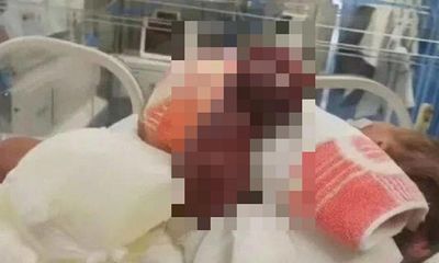 Tin tức đời sống ngày 22/11: Em bé sơ sinh suýt phải cắt cụt tay vì sai lầm của mẹ