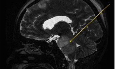 Tin tức đời sống ngày 21/3: Người đàn ông nấc cụt 4 tháng, đi khám phát hiện bị u não