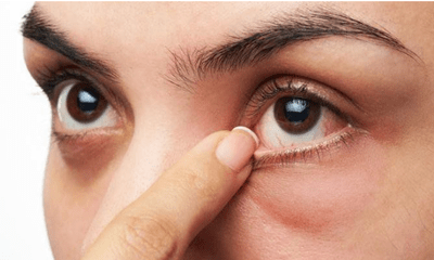Đi khám vì bị ngứa mí mắt, người phụ nữ được chẩn đoán mắc ung thư ác tính