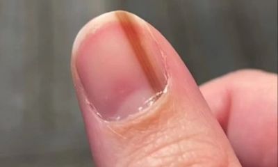 Vạch màu nâu bỗng xuất hiện trên ngón tay cô gái, sự thật hé lộ sau 10 năm gây bàng hoàng