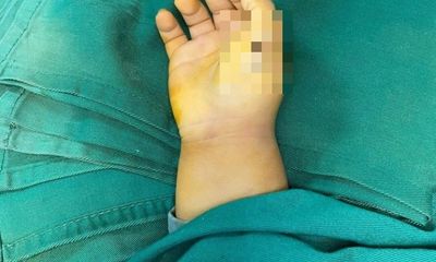 Sức khoẻ - Làm đẹp - Tin tức đời sống ngày 21/5: Phẫu thuật chỉnh hình cho bé 23 tháng tuổi mắc dị tật thừa ngón tay