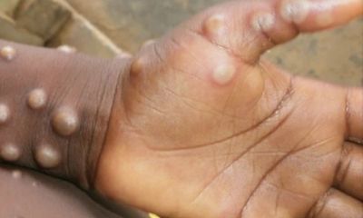 Quốc gia đầu tiên yêu cầu cách ly người mắc bệnh đậu mùa khỉ