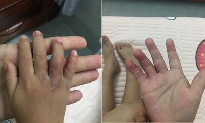 Sức khoẻ - Làm đẹp - Tin tức đời sống ngày 25/5: Tách thành công 2 bàn tay dính ngón cho bệnh nhi 19 tháng tuổi