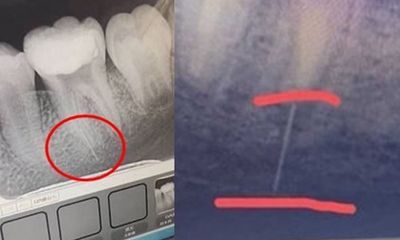Bé gái 13 tuổi gặp sự cố hi hữu khi điều trị tủy răng