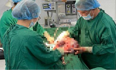 Tin tức đời sống ngày 18/7: Cắt khối u buồng trứng năng 10kg cho bệnh nhân 26 tuổi