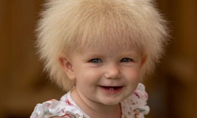 Hội chứng hiếm gặp khiến bé gái 18 tháng tuổi sở hữu mái tóc cực lạ