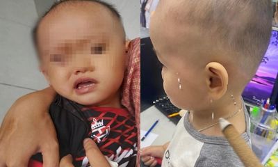 Bé trai 1 tuổi bị liệt mặt, méo miệng vì ngủ quạt sai cách