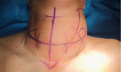 Tin tức đời sống ngày 28/9: Phẫu thuật cắt bỏ khối u tuyến giáp “khổng lồ” cho bệnh nhân 43 tuổi