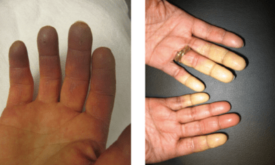 Hội chứng lạ khiến ngón tay người phụ nữ chuyển màu theo thời tiết, cảm xúc
