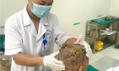 Bé trai ở Thanh Hóa bị chó cắn tổn thương nặng tại vùng đầu, mặt
