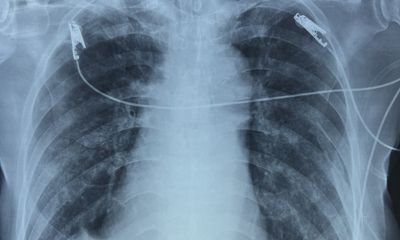 Tin tức đời sống ngày 24/11: Người đàn ông ngưng tim, ngưng thở do tràn khí màng phổi