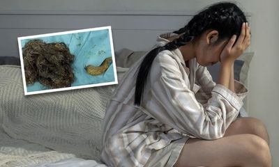 Hội chứng lạ khiến bé gái 14 tuổi có búi tóc nặng 3kg trong bụng