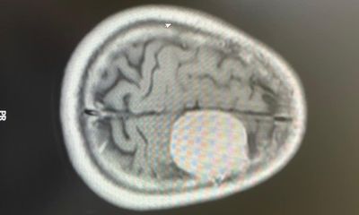 Tin tức đời sống ngày 4/12: Phát hiện khối u lớn trong não sau cơn đau đầu dữ dội