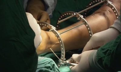 Cô gái 19 tuổi trả giá đắt khi làm phẫu thuật kéo dài chân