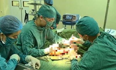 Phẫu thuật lấy khối dị dạng mạch máu bất thường ở tay trái cho người phụ nữ 50 tuổi
