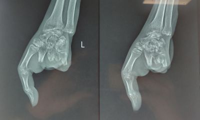 Phẫu thuật chuyển ngón chân thành ngón tay cho người phụ nữ gặp tai nạn với máy xay thịt