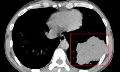 Tin tức đời sống ngày 16/1: Người đàn ông phát hiện khối u phổi lớn khi khám sức khỏe định kỳ
