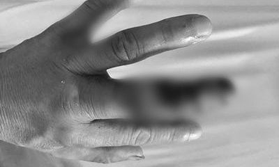 Tin tức đời sống ngày 1/5: Hoại tử phải tháo bỏ ngón tay vì tự ý đắp thuốc nam vào vết rắn cắn
