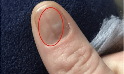Người phụ nữ phát hiện bị ung thư nhờ vết bầm trên móng tay