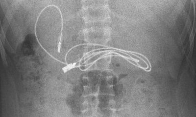 Phát hiện dây sạc dài gần 1 mét trong dạ dày bệnh nhân 15 tuổi