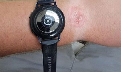 Công nghệ - Tin tức công nghệ mới nóng nhất hôm nay 22/9: Bỏng tay vì đeo Samsung Galaxy Watch qua đêm