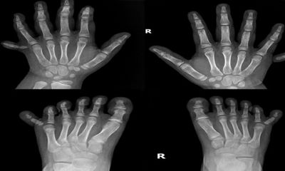 Phẫu thuật thành công cho bé gái có 12 ngón tay, 12 ngón chân hiếm gặp
