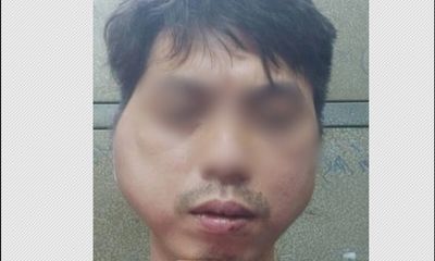 Thanh niên 29 tuổi tố bị chủ quán lẩu nướng ở Hà Nội đánh biến dạng khuôn mặt