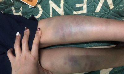 Vụ học sinh lớp 1 bị đánh bầm tím tay chân ở Đà Nẵng: Không khởi tố hình sự
