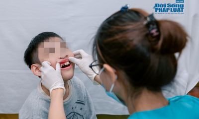 Gần 3000 trẻ em được sinh ra mắc dị tật khe hở môi – vòm miệng mỗi năm: Nhiều em sẽ được chỉnh nha miễn phí