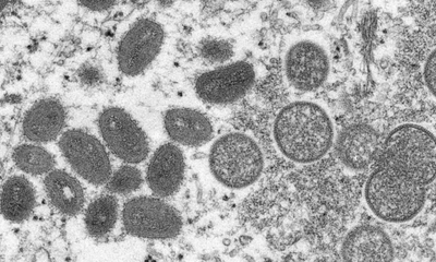 Virus đậu mùa khỉ đang lây lan trên thế giới đã có tới 47 đột biến
