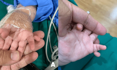 Phẫu thuật cho bé gái có 24 ngón tay, ngón chân do di truyền