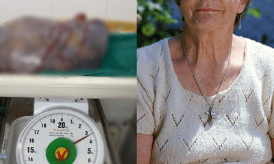 Cắt bỏ khối u buồng trứng 3,3kg cho cụ bà 77 tuổi