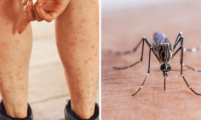 Giảm sưng ngứa sau con muỗi nhen chỉ với những đồ dùng sở hữu tức thì nhập ngôi nhà bếp