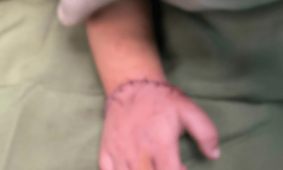 Em bé 18 tháng tuổi được nối liền bàn tay sau tai nạn từ máy cắt đá của gia đình