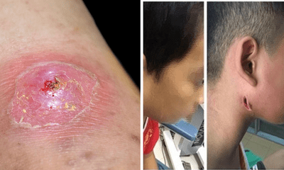 Nữ bệnh nhân ở Quảng Nam tử vong vì vi khuẩn 