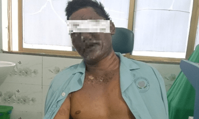 Người đàn ông bị bỏng biến dạng mặt vì nổ bình gas mini khi ăn lẩu