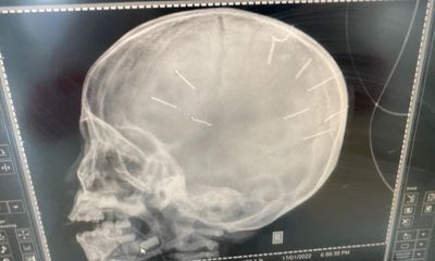 Hà Nội: Bé gái 3 tuổi nghi có 9 đinh găm vào đầu, có dấu hiệu bị bạo hành