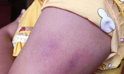 Vụ cô giáo đánh tím tay học sinh ở Đắk Lắk: Tạm đình chỉ 1 tuần để làm rõ 