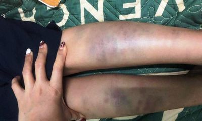 Đà Nẵng: Làm rõ vụ học sinh lớp 1 bầm tím chân tay sau khi tan học