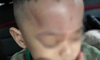 Nghi án bé 4 tuổi bị bạo hành tại trường mầm non ở Đà Nẵng