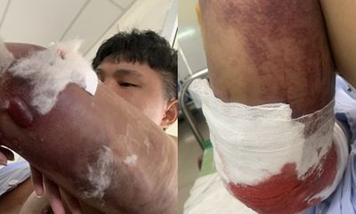 Vụ shipper bị đánh gãy 2 tay ở Quảng Ngãi: Đôi vợ chồng vẫn chưa xin lỗi nạn nhân 